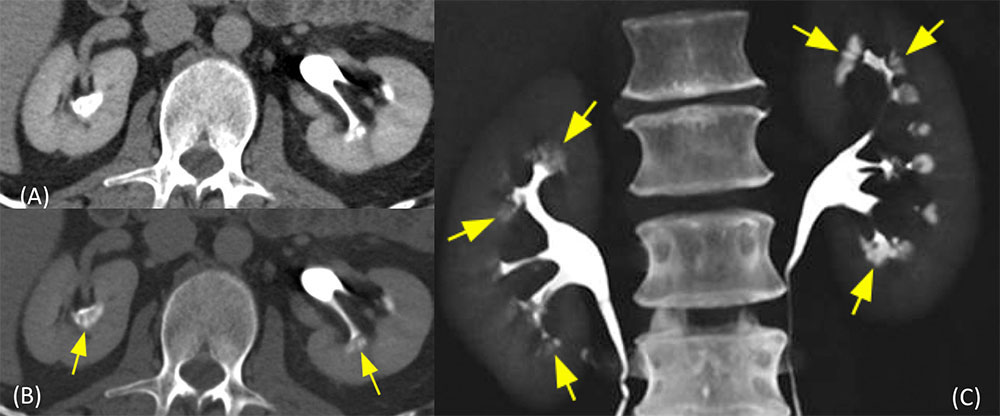 Benign Tubular Ectasia